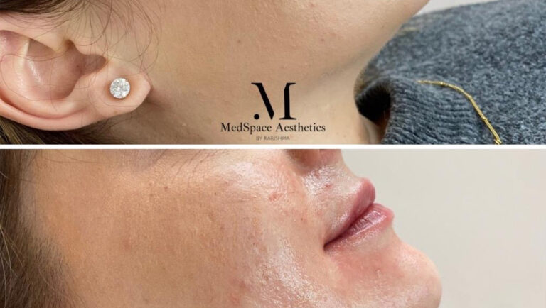 lip filler