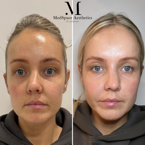 dermal filler before and after